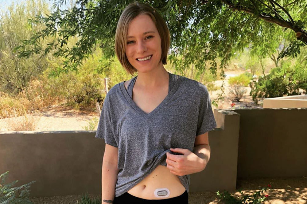 Author Alexi Melvin wearing a Dexcom CGM sensor