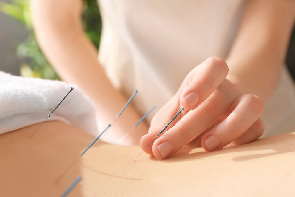 A person receiving an acupuncture treatment